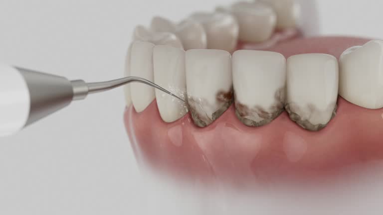 Trusted Wisdom Tooth Removal service in Laurel Springs, NJ - Dentist Open Now